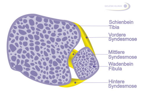 Schematische Ansicht der Syndesmosen im rechten Sprunggelenk von oben: Die Syndesmose besteht aus drei Anteilen: Wir unterscheiden ein vorderes, ein mittleres und ein hinteres Syndesmoseband. © Gelenk-Klinik Schema Lage Syndesmosebänder