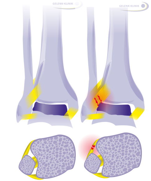 Schema verletztes Syndesmoseband