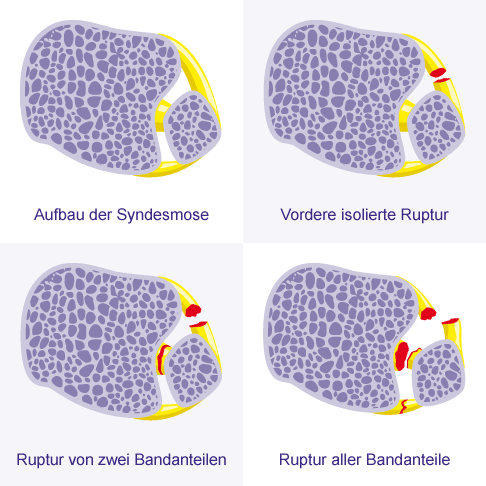 Verschiedene Formen der Syndesmosenruptur. Die vordere isolierter Ruptur ist stabil und kann gut konservativ behandelt werden. Die Ruptur von zwei oder mehr Bandanteilen ist instabil und erhöht das Risiko für bleibende Schäden. Sie bedarf einer operativen Behandlung, die abhängig von anderen Verletzungen am Knochen ist. Alle Bandanteile der Syndesmose können auch knöchern ausreißen. Die Behandlung bei knöchernen Ausrissen erfolgt durch operative Refixation. © Gelenk-Klinik Formen des Syndesmosebandrisses