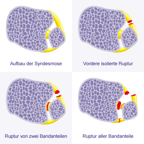 Formen des Syndesmosebandrisses