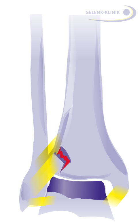 Ein Syndesmosenbandriss kann zur Aufweitung der Malleolengabel und damit zu einer verminderten Kontaktfläche führen. © Gelenk-Klinik Syndesmosebandriss mit aufgeweiteter Malleolengabel
