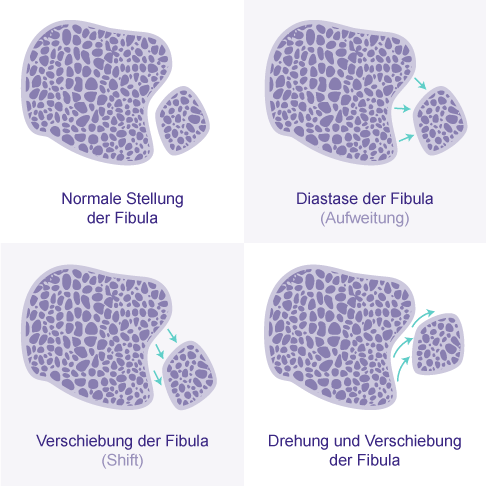 Schematische Darstellung der verschieden Fehlpositionierungen des Wadenbeins (Fibula). Diese Auswertung findet im Rahmen der digitalen Volumentomographie statt und hilft bei Bewertung und Einschätzung der Effekte auf die Sprunggelenksfunktion und die Prognose der Verletzung. Die Belastungsaufnahme gibt auch Hinweise auf den Kontaktverlust des Sprungbeins in der Sprunggelenksgabel mit erhöhtem Risiko für Sprunggelenksarthrose. © Gelenk-Klinik Formen des Syndesmosebandrisses