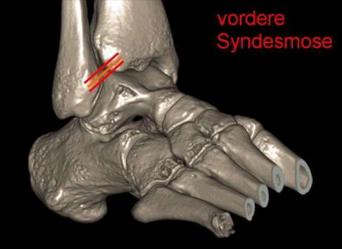Fuß mit Syndesmoseband