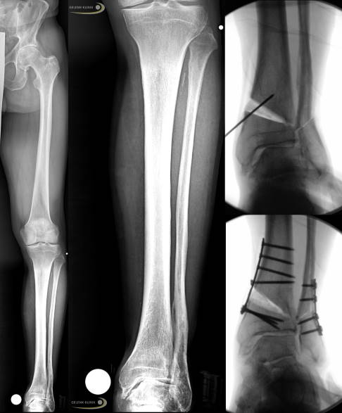 Die Behandlung der innen liegenden Arthrose am Sprunggelenk bei einem Hohlfuß erfolgte durch eine Begradigung und damit Horizontalstellung des Talus (Sprungbein). Je nach Ursache der Fehlstellung kommen eine Vielzahl von ergänzenden stellungskorrigierenden Maßnahmen in Frage. Auch Bandersatzoperationen, Sehnenverlagerungen oder auch nur Knochenabtragungen sind oft sinnvoll. Die Knorpelchirurgie wird häufig ergänzt. Es ist sinnvoll, diese Therapien auch bei Charcot-Marie-Tooth möglichst frühzeitig durchzuführen. © Gelenk-Klinik Röntgenbild: Behandlung einer Sprunggelenksarthrose durch Begradigung des Talus (Sprungbein).