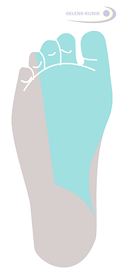 Das Versorgungsgebiet des Schienbeinnervs innen (medial) an der Fußsohle ist farbig markiert. Dieser Bereich ist beim Tarsaltunnelsyndrom besonders stark von Schmerzen, Taubheit und Missempfindungen betroffen. © Dr. Thomas Schneider Tarsaltunnelsyndrom: Versorgungsgebiet des Tibialisnervs an der Innenseite der Fußsohle