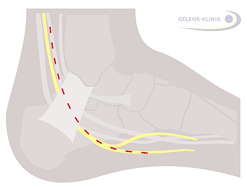 geplanter Operationsschnitt bei einem Tarsaltunnelsyndrom