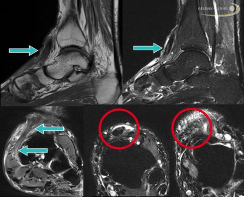 MRT-Bild (Magnetresonanztomografie) einer chronischen Ruptur der Tibialis-anterior-Sehne: Die oberen Bilder zeigen die Seitenansicht des Fußes. Die Sehnen sind normalerweise in ihrer gesamten Länge schwarz im MRT zu sehen. Hier ist eine deutliche Veränderung der Sehnenstruktur sichtbar. Der Sehnenverlauf am inneren Fußrücken ist in der Frontalansicht unten links dargestellt. Die roten Markierungen rechts und in der Mitte zeigen die Sehne in verschiedenen Abschnitten ihres Verlaufs. Im mittleren Bild sind noch teilweise gesunde Sehnenanteile sichtbar, die von einer Sehnenscheidenentzündung (weiße Darstellung oberhalb der Sehne) umgeben werden. Im rechten Bild ist die Sehne aufgrund der narbigen und degenerativen Veränderung kaum noch abzugrenzen. © Dr. Thomas Schneider MRT einer gerissenen Tibialis-anterior-Sehne