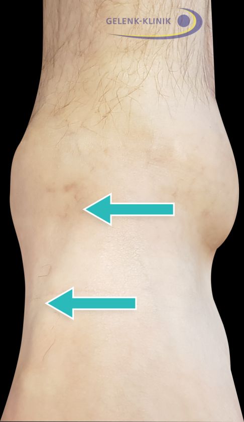 Klinisches Bild einer Ruptur der Tibialis-anterior-Sehne: Die Pfeile markieren den Sehnenverlauf am Innenknöchel des linken Fußes. Beim Anspannen kann man je nach Schädigung verschiedene Phänomene beobachten. Ist die Sehne vollständig gerissen, spannt sie sich nicht mehr an. Auf Höhe des oberen Pfeiles ist dann meist eine knotige Verdickung des Sehnenstumpfes tastbar. Bei einer Tendinose (Reizung der Sehne) ohne vollständige Ruptur kann auch nur eine Verdickung tastbar sein. Häufig ist dann der Sehnenansatz am inneren Fußrand druckschmerzhaft. © Dr. Thomas Schneider gerissene Tibialis-anterior-Sehne klinisch