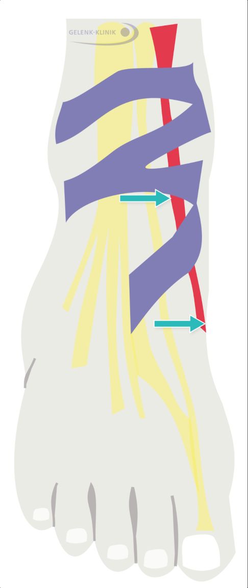 Links: Typische Lage der Tibialis-anterior-Sehne: Die Sehne (rot) verläuft von der Unterschenkel-Innenseite zum inneren Fußrand. Sie wird durch die Haltebänder (Retinakula, violett) stabilisiert. Gelb eingezeichnet sind die Strecksehnen der Klein- und Großzehen. typische Lage der Tibialis-anterior-Sehne