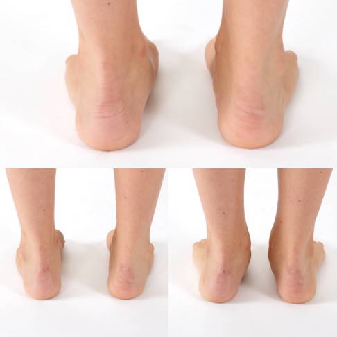 Das Fersenpendel reguliert die Stellung des Fersenbeins. © Gelenk-Klinik.de Fersenpendel: Übung zur Verbesserung eines Knick-Senkfußes