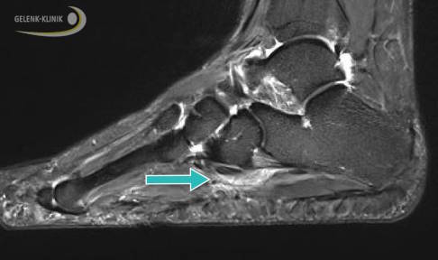 Deutliche Weichteilreizung im Verlauf der langen Peronealsehne unterhalb des Würfelbeines (Os cuboideum). Die Belastung des Fußes ohne spezielle Polsterung war sehr schmerzhaft. © Gelenk-Klinik Weichteilreizung der langen Peronealsehne