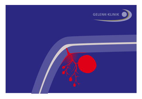 Schematische Darstellung einer Knochenzyste (rot), die durch eine Schädigung der darüberliegenden Knorpelschicht (weiß) entstanden ist. © Gelenk-Klinik Schematische Darstellung einer Knochenzyste