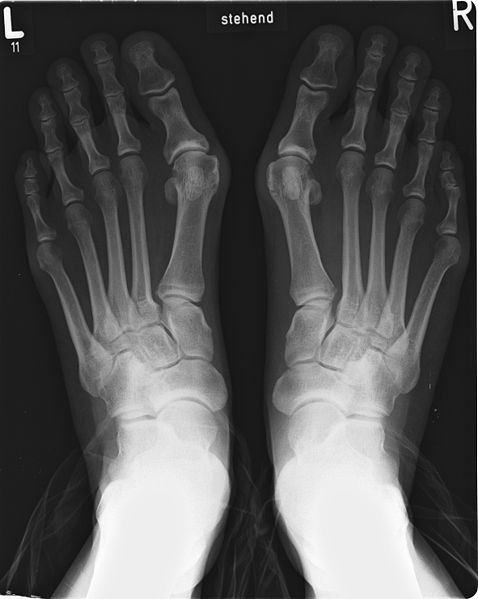 Patient mit Spreizfüßen von oben im Röntgen: Deutlich sichtbar sind die aufgefächerten Zehenstrahlen. Der Knick nach innen am Großzehengrundgelenk verursacht einen Hallux valgus. Die kleinen Zehen sind charakteristisch einwärts gedreht. © Gelenk-Klinik Auswertung der Ganganalyse bei einem Spreizfuß