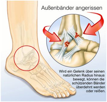 Meist sind Unfälle beim Sport für Verletzungen der Bänder am Sprunggelenk verantwortlich. Durch ein Umknicken des Fußes können die Bänder überdehnen oder reißen. © Henrie, Fotolia Bandruptur am Sprunggelenk