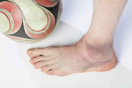 Verletzungen der Außenbänder äußern sich meist durch starke Schmerzen und Hämatombildung (Bluterguss). © Leo, Fotolia Bildung eines Blutergusses nach Außenbandriss.