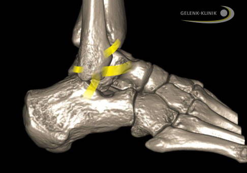 Die Außenbänder verbinden das Wadenbein (Fibula) mit dem Fersenbein und dem Sprungbein. Zudem verläuft das Syndesmoseband zwischen Schienbein und Wadenbein. © Gelenk-Klinik Außenbänder des Sprunggelenks
