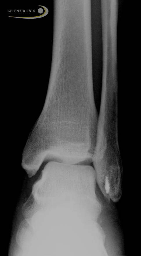 Das abgerissene Außenband wurde mit einem Fadenanker im Wadenbein (Fibula) befestigt. © Gelenk-Klinik Befestigung des Außenbandes mit einem Fadenanker am Wadenbein