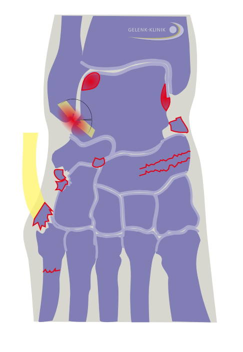 Neben einer Verletzung des Außenbandes kann es durch das Umknicktrauma zu weiteren Begleitverletzungen kommen. Diese Grafik zeigt einen Ausriss des Außenbandes aus seiner knöchernen Verankerung und knöcherne Verletzungen des Sprungbeins. © Gelenk-Klinik Riss des Außenbandes aus seiner knöchernen Verankerung