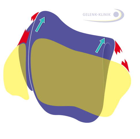 Sind Innen- und Außenband gerissen, besteht eine Instabilität des Sprunggelenks nach vorne. © Gelenk-Klinik Sprunggelenk von oben mit Innen- und Außenbandriss
