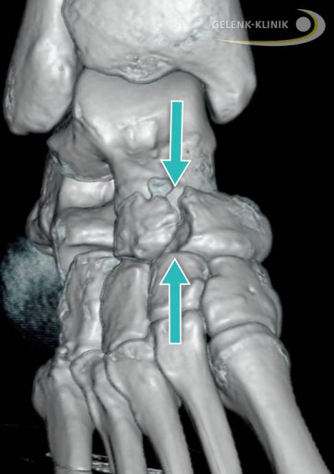 CT mit 3D-Darstellung einer verschobenen (dislozierten) Stressfraktur am Kahnbein. Der weite Abstand zwischen den beiden Kahnbeinanteilen und das links vom oberen Pfeil gelegene Knochenfragment sind Zeichen dafür, dass die Heilung nicht glatt verläuft Im Bild ist die anatomische Lage des Kahnbeins gut sichtbar: In Richtung Körper der Kontakt zum Sprunggelenk, zu den Zehen hin der Kontakt zu den drei Keilbeinknochen. © Gelenk-Klinik CT: verschobene Stressfraktur des Kahnbeins.
