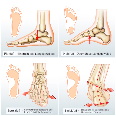 Jede Fehlstellung hat ihre eigenen Ursachen und Auswirkungen. Eine frühzeitige Diagnose und Behandlung können helfen, Schmerzen und Folgeschäden zu vermeiden. © Henrie, Adobe Grafische Darstellung verschiedener Fußfehlstellungen