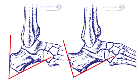 Fowler-Winkel zur Bestimmung einer Haglundferse