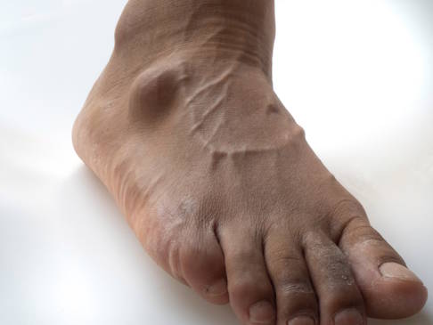 Wenn das Ganglion am Fuß sitzt, kann es im Schuh drücken und Probleme beim Gehen bereiten. © Aimdeemeesuk, Adobe Ganglion am Fuß