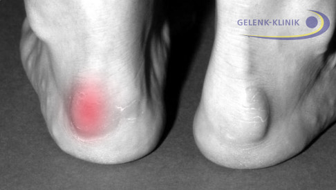 Die Haglundferse ist eine Formabweichung des Fersenbeins (Calcaneus), die auch von außen deutlich sichtbar ist. © Gelenk-Klinik Klinisches Bild einer Haglundferse