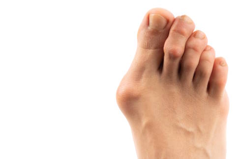 Die Schiefstellung der Großzehe und der hervortretende Zehenballen sind die typischen Symptome des Hallux valgus. © Gelenk-Klinik nach außen geknickte Großzehe