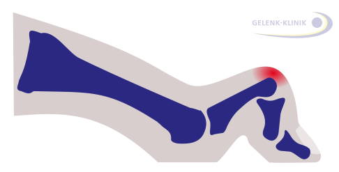 Hammerzeh mit charakteristischer Beugung des Endglieds. © Gelenk-Klinik Hammerzeh