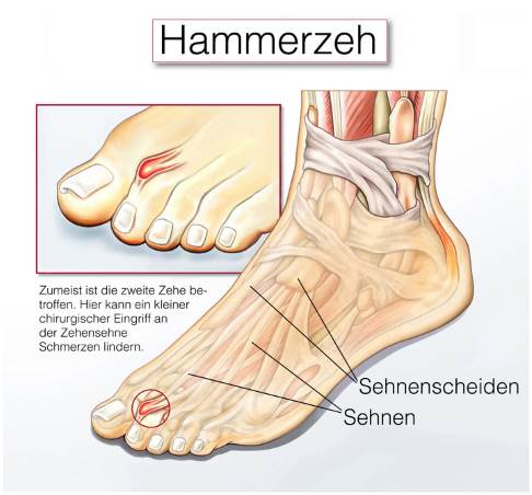 Der Hammerzeh äußert sich durch eine Fehlstellung des Mittelglieds nach oben, sodass es zu einer Beugung des Endglieds kommt. Dies verleiht dem Zeh sein typisches krallenartiges Aussehen. © Henrie, Fotolia Hammerzeh