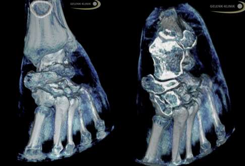 Darstellung eines einseitigen linken Klumpfußes mittels digitaler Volumentomografie (DVT). In diesem röntgenbasierten Verfahren erhält der Untersucher eine 3-dimensionale Darstellung der knöchernen Strukturen. Hier sind die Restfehlstellungen nach einer früher erfolgten Klumpfuß-Operation in zwei Ebenen abgebildet. © Gelenk-Klinik DVT; Restfehlstellung des Klumpfußes nach der Operation