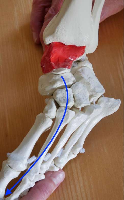 Die komplexen Fußdeformationen beim Klumpfuß haben ihre Ursache in Verschiebungen der Knochen unterhalb des Sprungbeins (Talus, hier rot dargestellt), zusammen mit verkürzten Bandstrukturen und gestörter Muskelspannung. © Gelenk-Klinik Fußknochen mit Markierung des Sprungbeins
