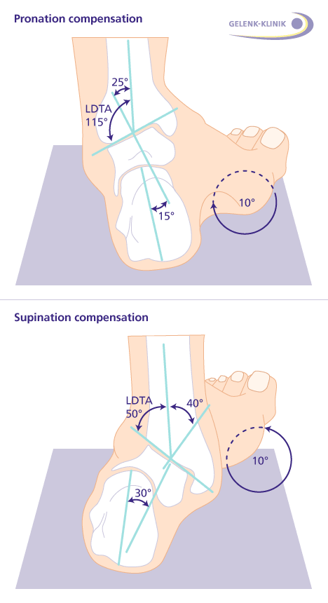 Patientenfuß nach Versteifung des unteren Sprunggelenkes (Arthrodese): Mittelfristig gleicht der Vorfuß die fehlende Beweglichkeit im unteren Sprunggelenk mit einer kompensierenden leichten Verdrehung aus. a. Die Pronation wird durch eine Vorfußverdrehung in die Gegenrichtung um 10 Grad reduziert. b. Die Supination wird durch entgegengesetzte Verdrehung des Vorfußes um 10 Grad verringert. © Gelenk-Klinik Versteifung des Sprunggelenks