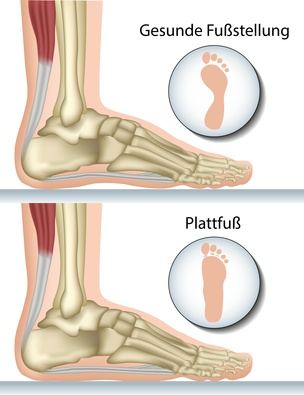 Beim Knick-Senkfuß sackt das Fußlängsgewölbe aufgrund einer Schwäche der Tibialis-posterior-Sehne ab. © bilderzwerg, Fotolia Knick-Senkfuß