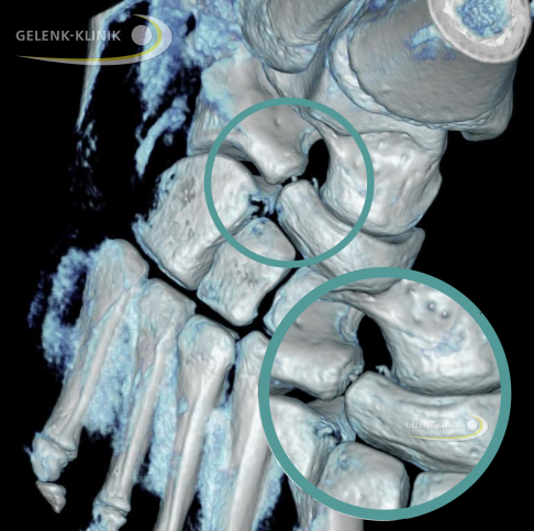 Digitale Volumentomographie einer inkompletten Coalitio calcaneonavicularis. Zwischen dem rechts liegenden Kahnbein und dem links oben liegendem Fersenbein besteht eine Brücke aus Bindegewebe. © Gelenk-Klinik Digitale Volumentomographie einer inkompletten Coalitio calcaneonavicularis
