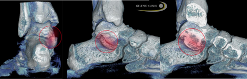 DVT-Darstellung einer partiellen Coalitio mit deutlichen Arthrosezeichen. Rot markiert ist ein knöcherner Kontakt zwischen Sprungbein (Talus) und Fersenbein (Calcaneus). © Gelenk-Klinik DVT mit Arthrose