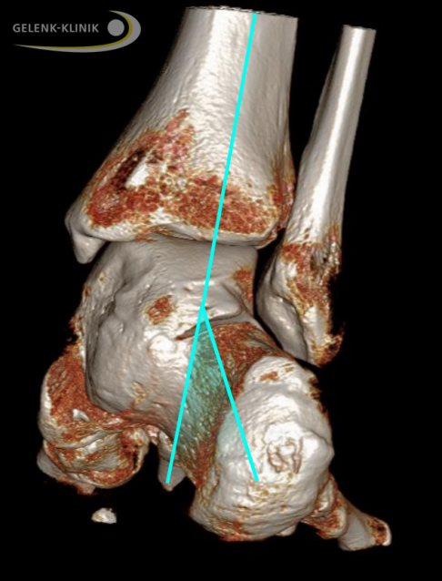 3D-Bildgebung durch DVT unter Belastung bei talocalcanearer Verwachsung: Die Verwachsung zwischen Sprungbein und Fersenbein wird im Detail gezeigt. Die abweichende grüne Linie von der Mittellinie markierte die massive Fehlstellung der Ferse zur anatomisch korrekten Stellung. © Gelenk-Klinik DVT unter Belastung