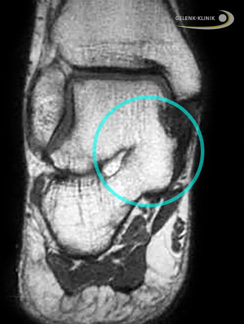 Magnetresonanztomographie (MRT) bei einem Patienten mit kompletter Koalition zwischen Sprungbein und Fersenbein (Kreis). Blick von hinten auf die Ferse: Rechts besteht eine nicht normale Verbindung der beiden Knochen. Man spricht von einer talokalkanearen Koalition. © Gelenk-Klinik Magnetresonanztomographie (MRT) bei einem Patienten mit kompletter Koalition