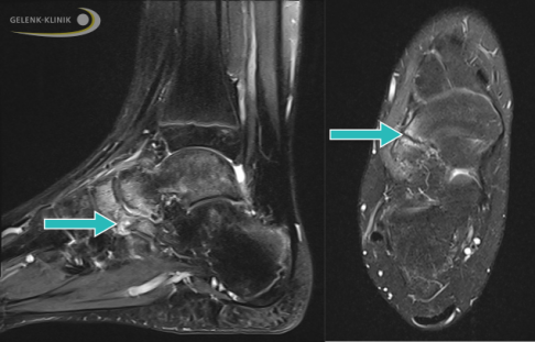 MRT eines Jugendlichen mit Koalition zwischen Fersenbein und Kahnbein (Coalitio calcaneonavicularis, Pfeil). Knochenstrukturen erscheinen im MRT dunkel. Die sichtbaren weißen, knöchernen Veränderungen sind mit einer vermehrten Flüssigkeitsansammlung gleichzusetzen (Knochenödem) und deuten auf eine Reizung des Knochens hin. © Gelenk-Klinik MRT eines Jugendlichen mit Koalition