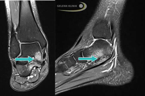 Magnetresonanztomographie (MRT) einer partiellen Koalition zwischen Sprungbein und Fersenbein (Pfeil) mit deutlichem Knochenödem als Zeichen einer akuten Entzündung. © Gelenk-Klinik MRT einer partiellen Koalition