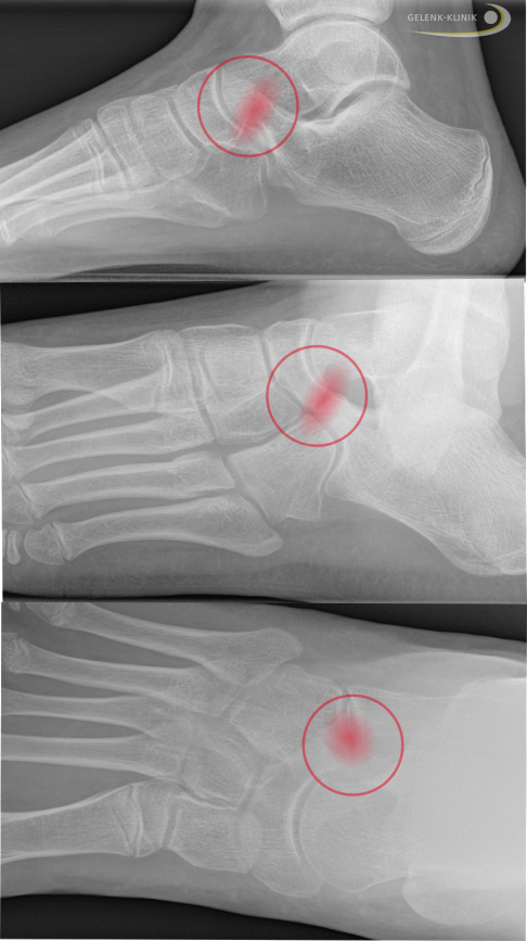 Röntgenbefund einer Coalitio calcaneonavicularis in 3 Ebenen (von der Seite, Schrägaufnahme, von oben). Man erkennt die bandförmige knöcherne Verbindung zwischen Fersenbein und Kahnbein (rot). © Gelenk-Klinik Röntgenbefund einer Coalitio calcaneonavicularis