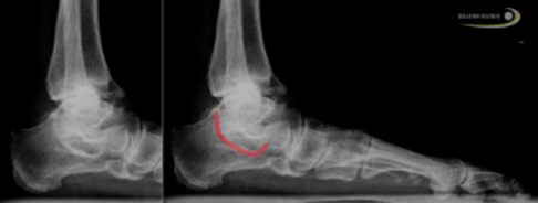 Röntgenaufnahme einer Coalitio talocalcanearis: Die rote Linie markiert die Verknöcherung zwischen Talus und Calcaneus und bildet ein liegendes "C." © Gelenk-Klinik Röntgenaufnahme einer Coalitio talocalcanearis