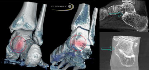 Darstellung einer vollständigen Coalitio talocalcanearis in DVT und Röntgen. © Gelenk-Klinik Darstellung einer vollständigen Coalitio talocalcanearis im Röntgen und durch DVT