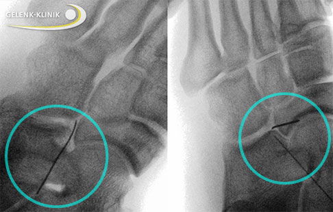Röntgenaufnahme während der minimalinvasiven Operation einer Coalitio calcaneonavicularis bei einem Jugendlichen mit geschlossenen Wachstumsfugen. Unter Bildwandlersicht wurde eine Nadel im Bereich der Verwachsung zwischen Kahnbein und Fersenbein platziert. Die Abtragung der Koalition erfolgte endoskopisch. © Gelenk-Klinik Röntgenaufnahme während der minimalinvasiven Operation