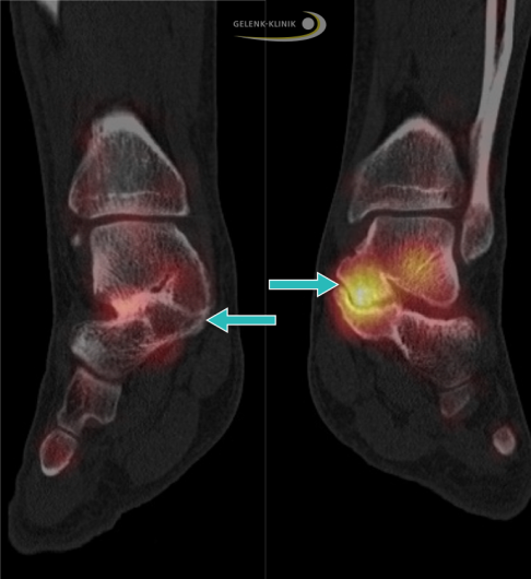 SPECT-Untersuchung, links: reizfreie Koalition ohne Tracer-Anreicherung. Rechts: aktiver Knochenstoffwechsel einer Koalition zwischen Sprungbein und Fersenbein bei einem Erwachsenen mit beginnender Arthrose. Die starke Anreicherung des Tracers steht im Zusammenhang mit den Schmerzen des Patienten. © Gelenk-Klinik SPECT im Vergleich
