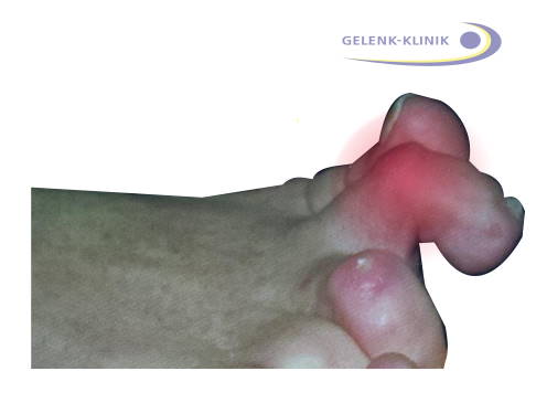 Anhand des charakteristischen Aussehens des Krallenzehs erkennt der Arzt die Zehenfehlstellung in der Regel per Blickdiagnose. © Gelenk-Klinik Klinisches Bild eines Krallenzehs