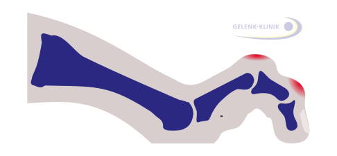 Krallenzehen äußern sich durch eine Überstreckung im End- und Grundglied und eine Beugung im Mittelglied des Zehs. © Gelenk-Klinik Krallenzeh