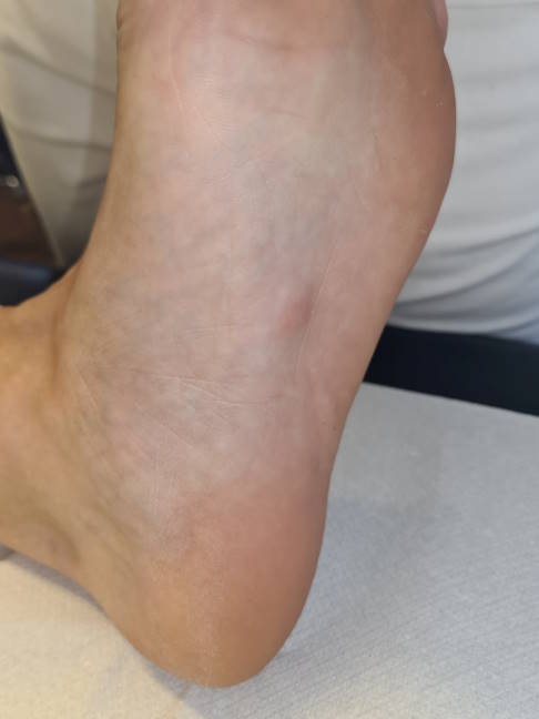 Beim Morbus Ledderhose bilden sich Knoten an der Fußsohle. Sie können schmerzen und beim Gehen stören. © Gelenk-Klinik klinisches Bild eines Morbus Ledderhose