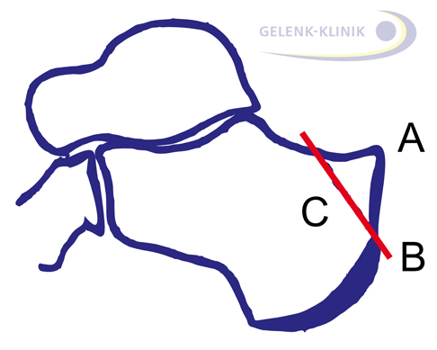 Planungsskizze: Der Knochenkeil am oberen Ende des Fersenbeins soll in einer minimalinvasiven Operation abgetragen werden. © Gelenk-Klinik Planungsskizze für die Operation der Haglundferse